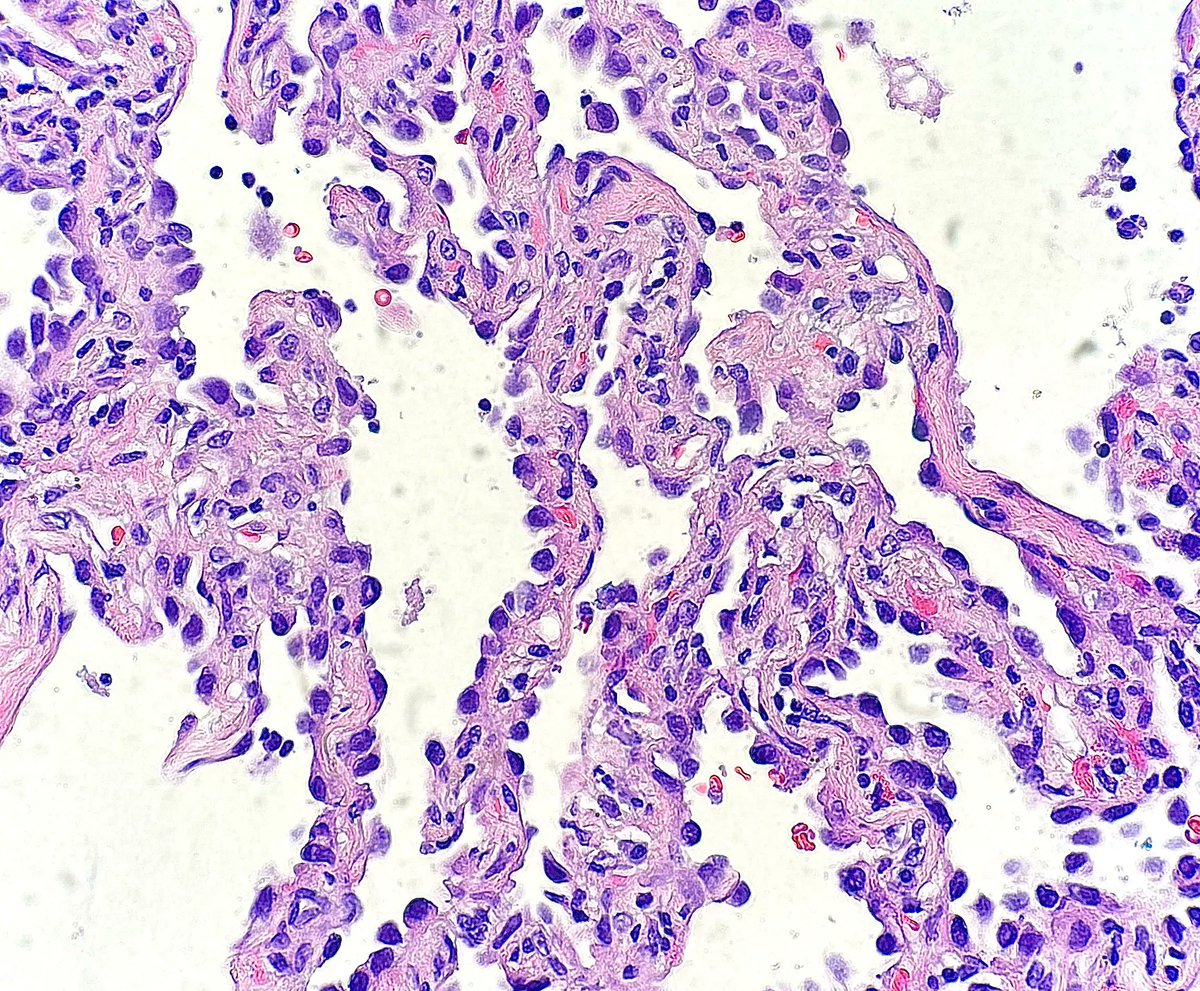 Tumor with an EGFR p.G719A mutation. What type of tumor is shown? Answer: kikoxp.com/posts/18719 #PathTwitter #MolPath #MedTwitter #PathArt