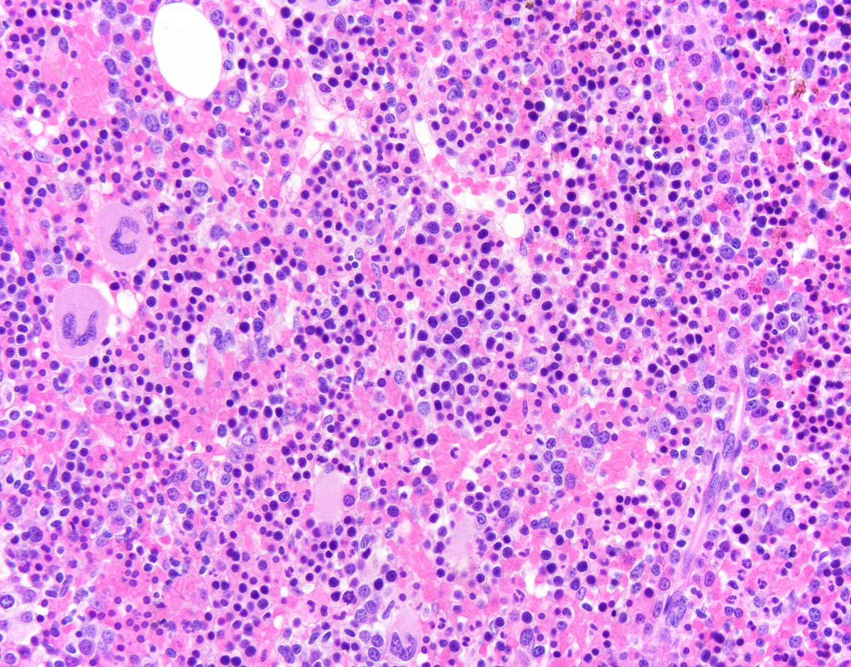 jake_bledsoe's tweet photo. Bone marrow from a patient with severe anemia. Diagnosis? #hemepath #pathology https://t.co/atEf7tmWjI