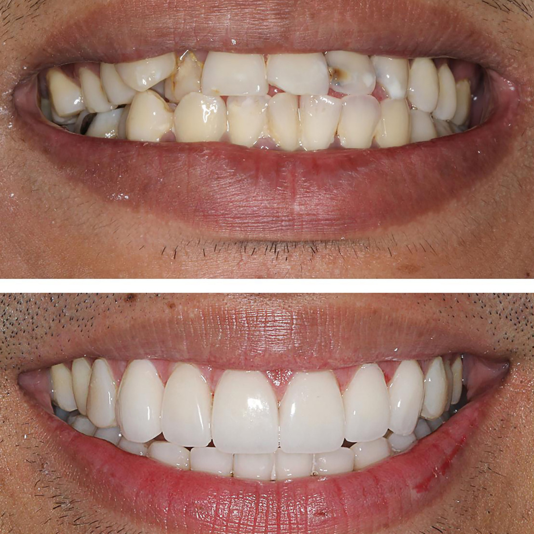 drdecardenas's tweet photo. If you have bad teeth and experience common teeth issues, we can help

Call us to schedule your consultation. Let us help you on your journey to a beautiful smile.

#miamicosmeticdentist #cosmeticdentistry #cosmeticdentist #cosmeticdentists #invisalignaligners #invisalignprovider https://t.co/tmlS34sidI