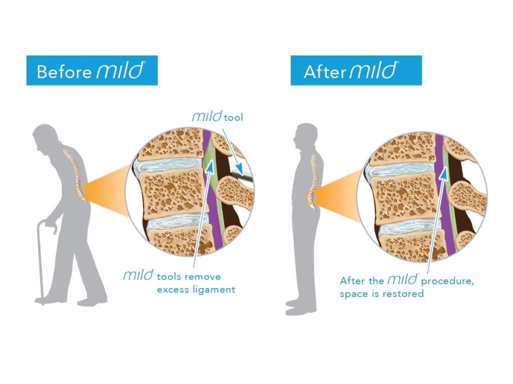 Relievus's tweet photo. mild® is a safe procedure that can help patients diagnosed with lumbar spinal stenosis (LSS) stand longer and walk farther with less pain.
https://t.co/QIRNDO6vAG
https://t.co/jyeBQAJnR2
888-985-2727
#painmanagement #managepain #relievepain #mildprocedure #righttreatment https://t.co/78sGpC88SG