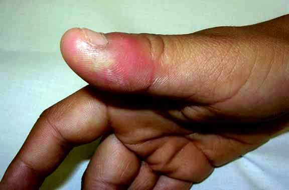 godwin_ugoo's tweet photo. WHITLOW
Whitlow is a disease of the thumb and fingertips, but can rarely infect the toes and nail cuticle. It normally begins with intense itching and pain. #Whitlow @who @CDCgov
It is of two types
1. Herpetic Whitlow and
2. Melanotic Whitlow. https://t.co/BhceWEXDfs