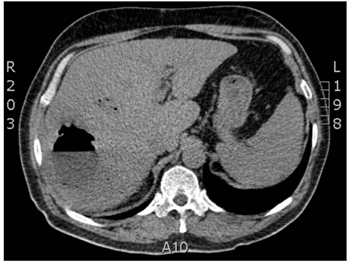 drkeithsiau's tweet photo. Management of liver abscess #MedEd #LiverTwitter

Via @FrontGastro_BMJ 
https://t.co/dSA8GtZozn https://t.co/DatpfYy1BY