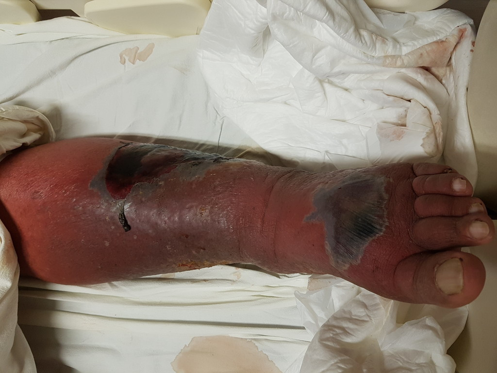 My illness - how it all started. 
Pics are on Google Drive, URL shortener used to create link. There is no malicious BS.
r.sa-seo.com/krankheit
If you have a sensitive stomach be aware - this is not a pretty sight.
There will be more along the way from 2016 to now.