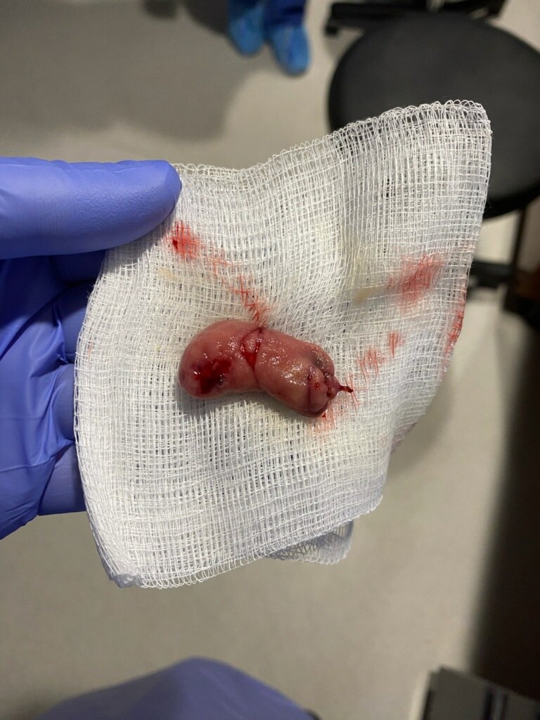VKesarMD's tweet photo. 5 cm symptomatic duodenal lipoma
@Mehershahi1988 #interventionalfellow
#polyloop #Olympus https://t.co/lFECHf1E1X