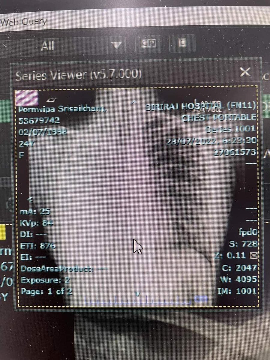 ไม่ได้รังเกียจคนดูดบุหรี่​ แต่รังเกียจคนที่ดูดบุหรี่ผิดที่​ สงสารเคสนี้มากเลย​ ขอให้หายไวๆนะคะ เขาอายุ 24 เองค่ะแต่เป็นมะเร็งปอดระยะที่ 4 แล้ว​ที่ทุกคนเรียกว่าระยะสุดท้าย​ ตอนนี้ฉายแสงไปแล้ว 10 ครั้งเขาแจ้งว่า​คิดว่าสาเหตุน่าจะมาจากการอยู่ใกล้คนสูบบุหรี่ เป็น second hand smoker