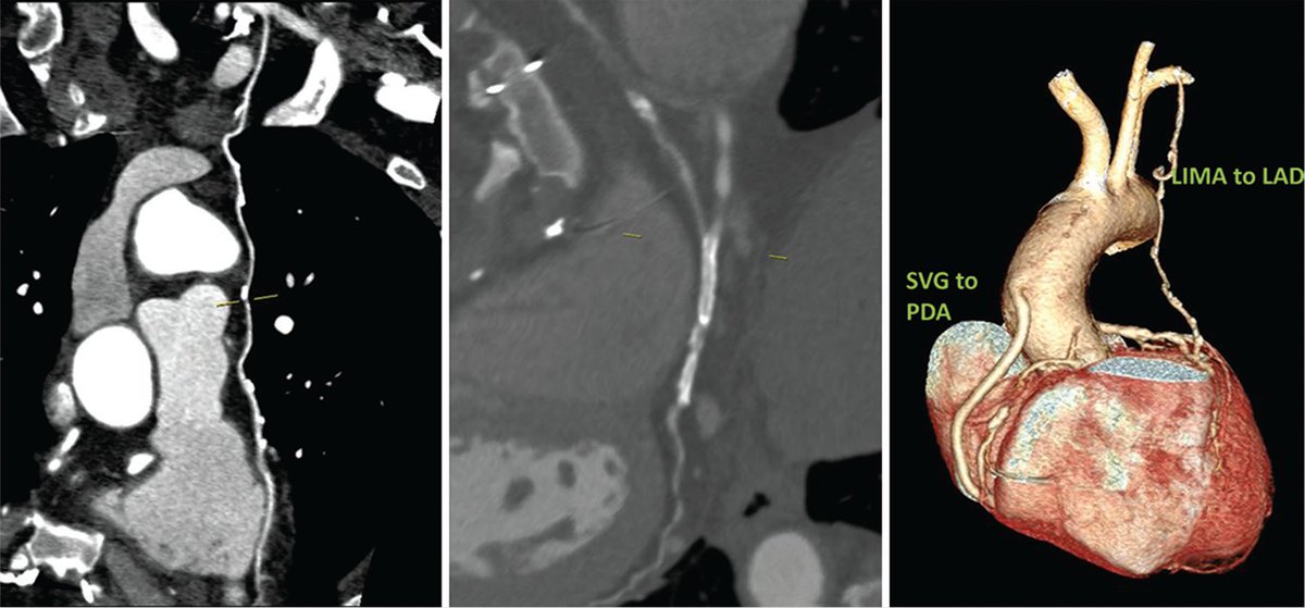Women in Cardiology and Related Sciences (@ijcdw_wincars) on Twitter photo Read the article “Role of MDCT in Assessment of Long-term Graft Patency in Female Patients” which explaining CABG is a good non invasive alternative for CAG in post CABG women
Learn more at ijcdw.org/role-of-mdct-i…
#ijcdw #CABG #surgery #cardiology Read the article “Role of MDCT in Assessment of Long-term Graft Patency in Female Patients” which explaining CABG is a good non invasive alternative for CAG in post CABG women
Learn more at ijcdw.org/role-of-mdct-i…
#ijcdw #CABG #surgery #cardiology