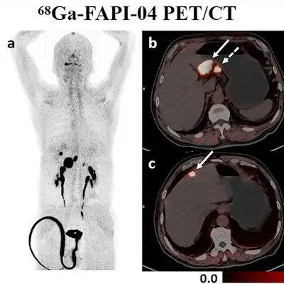 How best can you use #petct to diagnose early #gastriccancer? What's the optimum technique? New paper in #EurRadiol provides answers. buff.ly/3FDpugk #radiology #nuclearmedicine #petscan @ESR_Journals