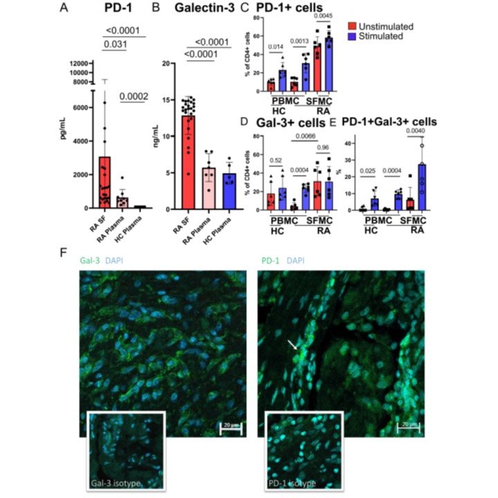 CzerwinsMarcin's tweet photo. Galectin-3 interacts with PD-1 and counteracts the PD-1 pathway-driven regulation of T cell and osteoclast activity in Rheumatoid Arthritis  https://t.co/qmA39cSBKJ

#glycotime https://t.co/T8rlbcyeNk