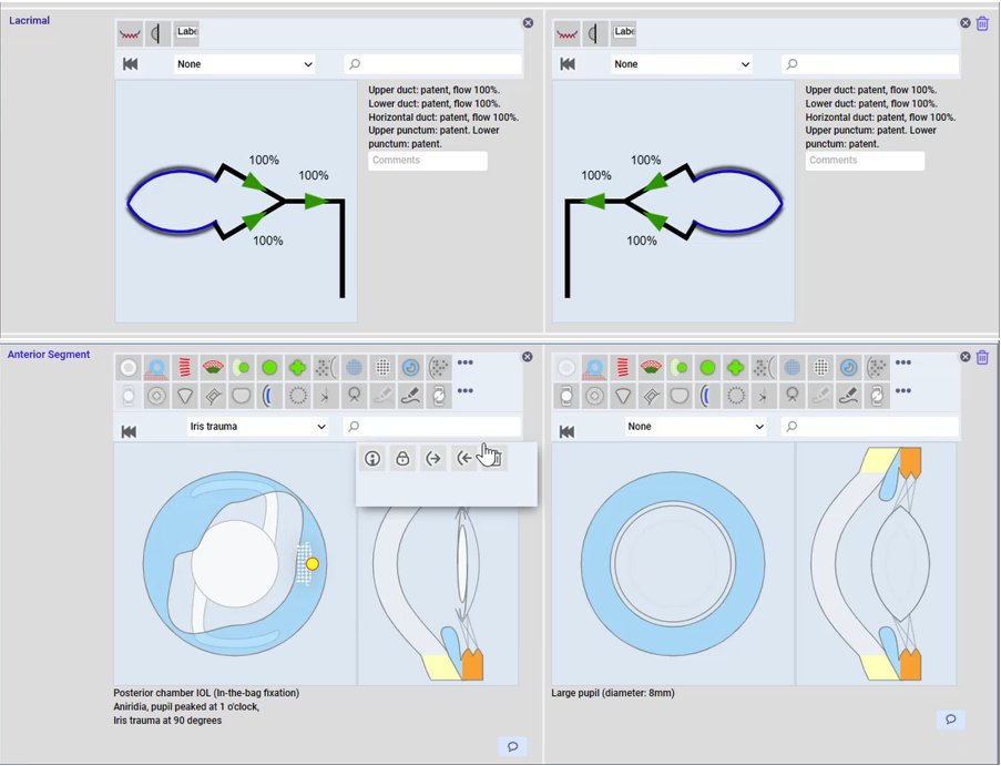 OpenEyes is constantly evolving. New Doodles for Lacrimal, Pupil Distortion and Trauma.

For a free demo, please contact Info@mdit.uk

#openeyes #appertafoundation #ophthalmology #ophthalmologist #eyecare #eyedoctor #eyecareprofessionals #eyesurgeon #eyehealth #optometrist