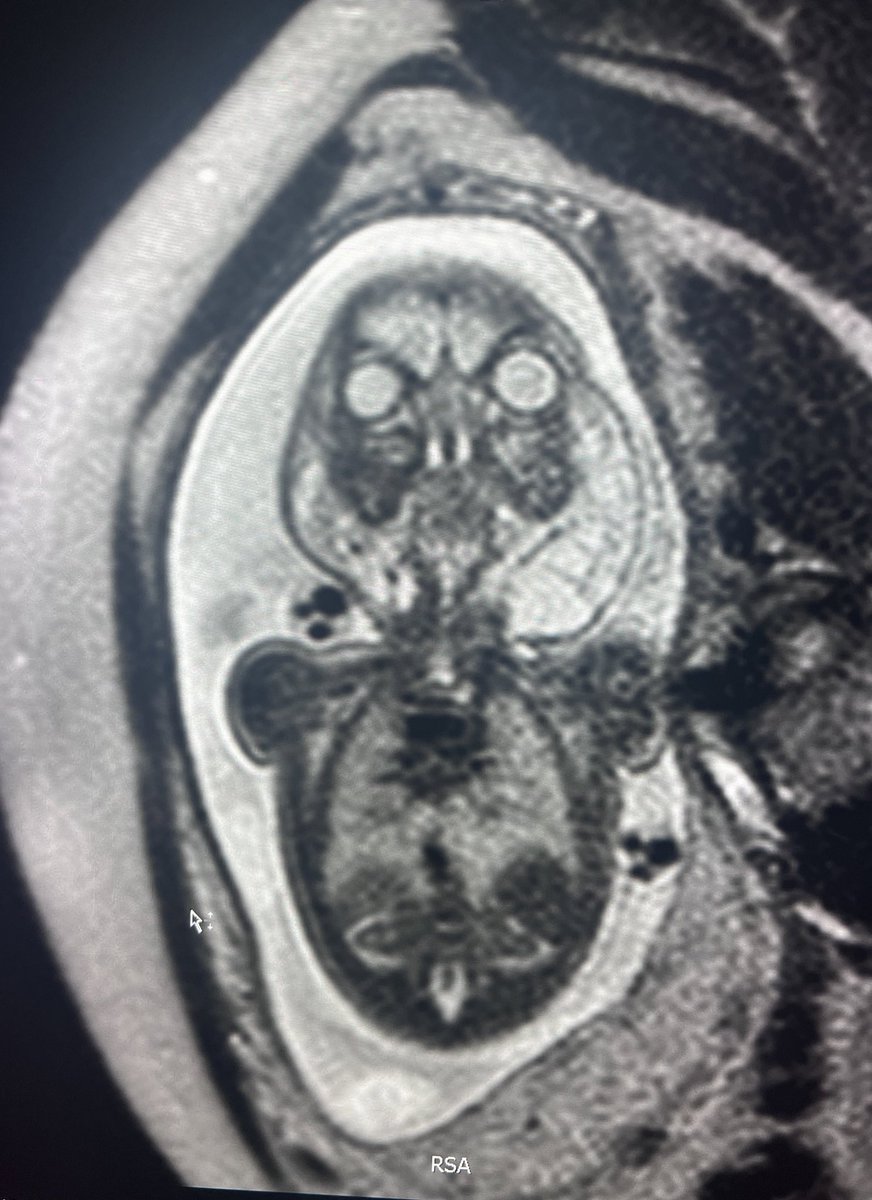 Dtepl's tweet photo. Today's case: prenatal MRI of a #lymphaticmalformation of the neck and postnatal ultrasound. Didn't require EXIT procedure. Will start #sclerotherapy with doxycycline https://t.co/OT1ZCaALNE