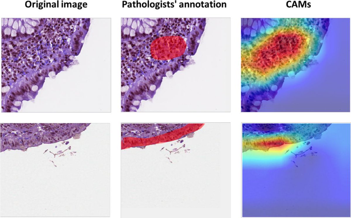 Included (in no particular order) as a #GUTTopPaper chosen by <a href="/emadelomar/">Emad El-Omar</a> is 

"PICaSSO Histologic Remission Index (PHRI) in UC: development of a novel simplified histological score for monitoring mucosal healing..." via

bit.ly/3E3A92H

<a href="/MariettaIacucci/">Marietta Iacucci</a> @NIHRBhamBRC