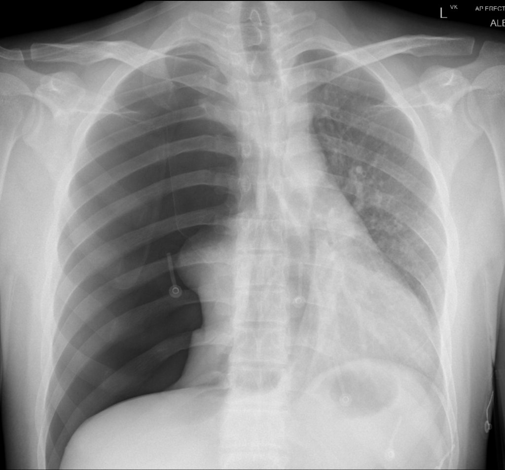 BrownJHM's tweet photo. A 20 year old man presented with pleuritic chest pain and shortness of breath. No history of trauma. What is the likely diagnosis? (Image @Radiopaedia, case by Craig Hacking) #Medtwitter https://t.co/hR9N9coDGs