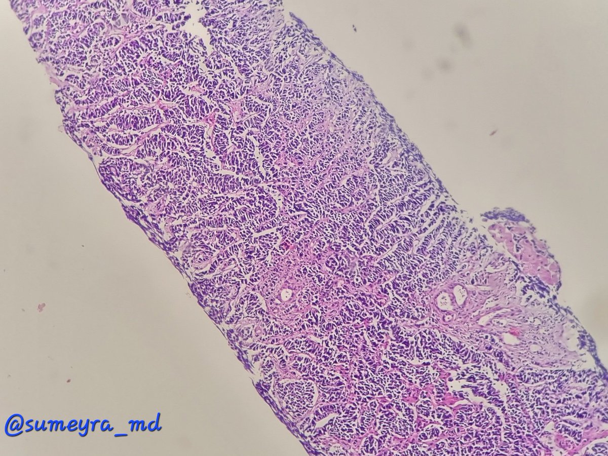 sumeyra_md's tweet photo. 1) Liver biopsy, 64-year-old man with a tumor in right lung, multipl liver and bone metastasis. Please feel free to explain your thoughts. 
#PathTwitter
to be continued👇🏼 
@DrGeeONE @PoloniaAntonio @NewjobiRakesh @girlscouter @saray_gonul https://t.co/WzEjxwoBP8