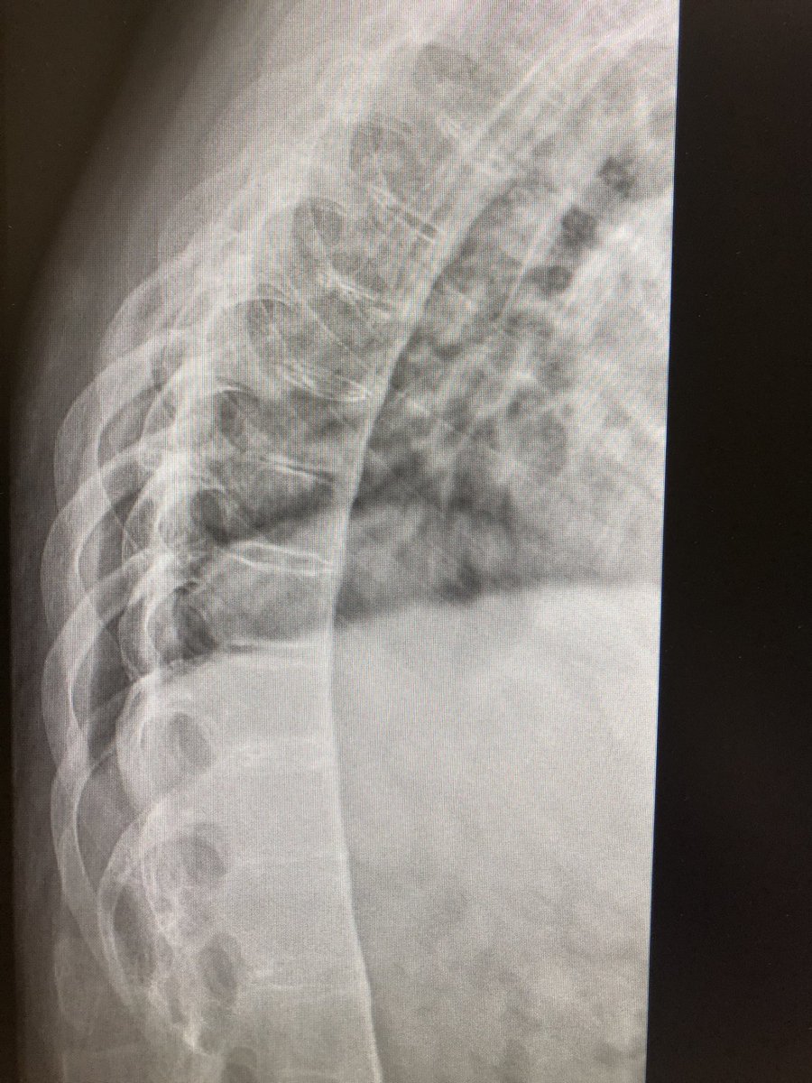 alla_ajten's tweet photo. How sensitive is MRI to detect inflammation?
#MedTwitter #rheumatology 
46yo male patient with HLA-B27+ SPA, compete ankylosis of spine and complete ankylosis of SIJ, still had IBP and CRP 20-23mg/L. STIR T2 MRI spine-no BMO. Spectacular improvement with TNFi! https://t.co/D1DdbQy7wy