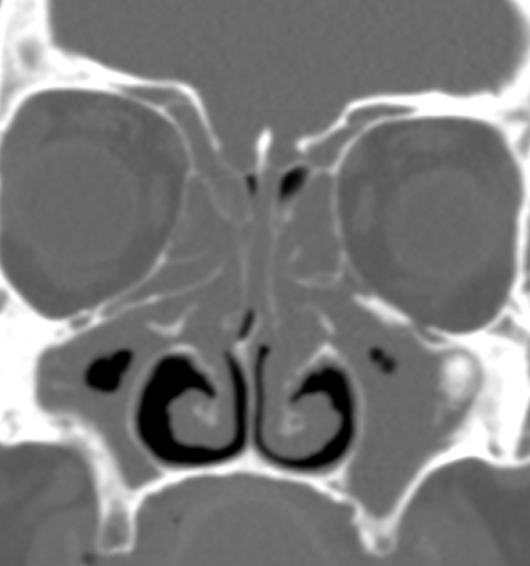 DrScottFortune's tweet photo. First patient of the #RhinologyClinic today #Grade2 #NasalPolyps on endoscopy #Imaging #SinusCTscan #radiology #CRSwNP https://t.co/vvH9qaRbeJ