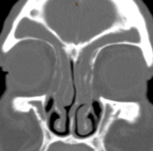 DrScottFortune's tweet photo. First patient of the #RhinologyClinic today #Grade2 #NasalPolyps on endoscopy #Imaging #SinusCTscan #radiology #CRSwNP https://t.co/vvH9qaRbeJ
