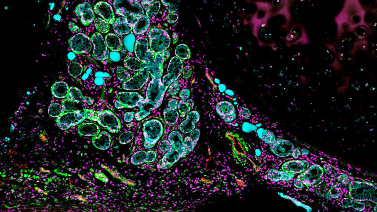 The most comprehensive lung cell atlas to date has revealed 11 new lung cell types and offers detailed insight into an immune process involved in fighting lung infections 🫁

#singlecell  #spatialtranscriptomics 

Read more below⤵️

bit.ly/3Vh9TsX