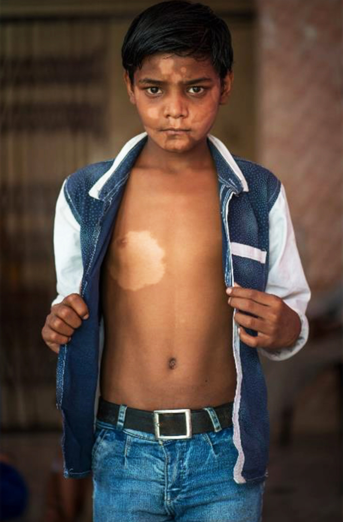 To help fight #leprosy, a devastating disease, DATUM's healthcare project for 2023 is the renovation of the existing Sonepur Leprosy Care Centre in Odisha State, #India.
This Christmas you can help raise money for DATUM by donating online #JustGiving ❤️🎁

justgiving.com/campaign/DATUM…