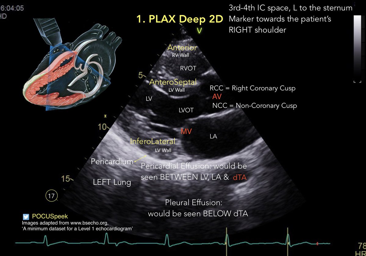 POCUSpeek's tweet image. Annotated PLAX views #firstecho #POCUS for @BSEcho level 1 or #FUSICheart @pocusfoamed 
🧵 PLAX Deep 2D 👇