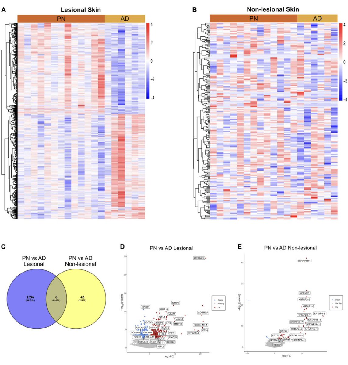 drshawnkwatra's tweet photo. Happy to share our study by @junedeng10 &amp; team on what’s unique in prurigo nodularis compared to atopic dermatitis - https://t.co/lEkVDe25jV

⬆️ TGF-beta signaling and dermal NGF

⬆️ OSM - in line with trial results showing failure of OSM inhibitors in AD but promising data in PN https://t.co/vQCQo9NGKO