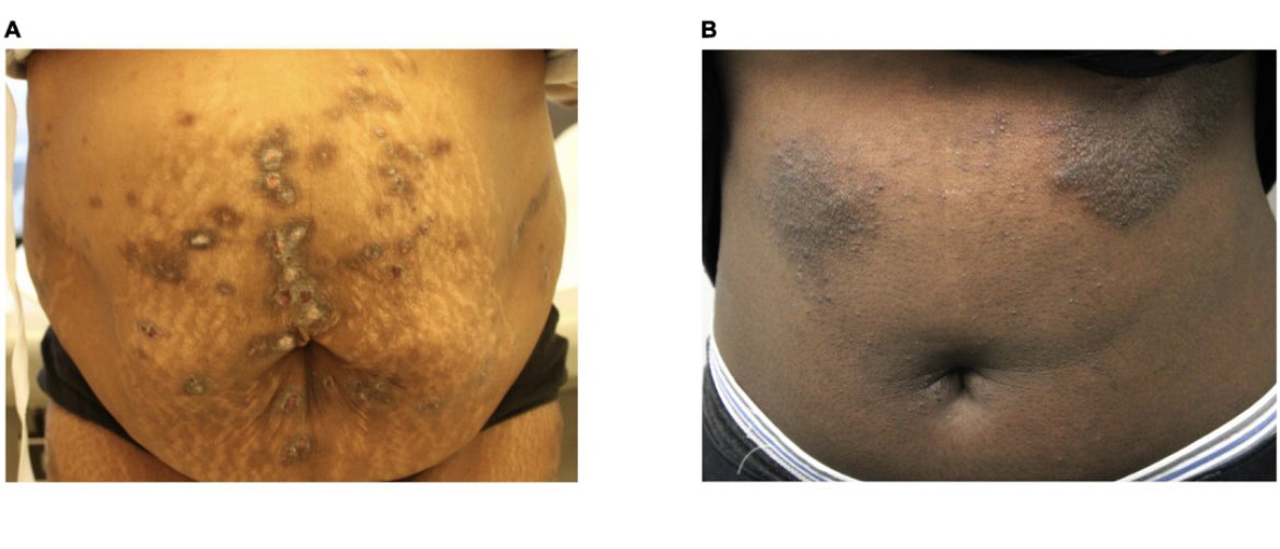 drshawnkwatra's tweet photo. Happy to share our study by @junedeng10 &amp; team on what’s unique in prurigo nodularis compared to atopic dermatitis - https://t.co/lEkVDe25jV

⬆️ TGF-beta signaling and dermal NGF

⬆️ OSM - in line with trial results showing failure of OSM inhibitors in AD but promising data in PN https://t.co/vQCQo9NGKO