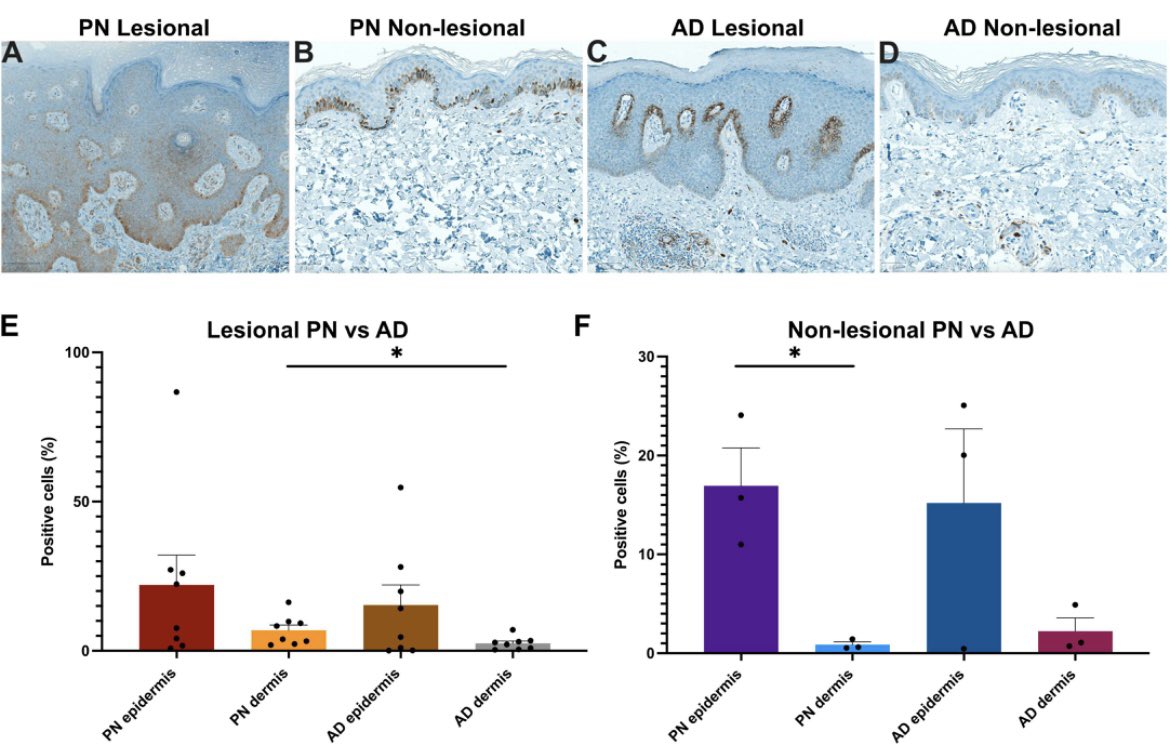 Happy to share our study by <a href="/junedeng10/">June Deng</a> &amp; team on what’s unique in prurigo nodularis compared to atopic dermatitis - bitly.ws/y7QP

⬆️ TGF-beta signaling and dermal NGF

⬆️ OSM - in line with trial results showing failure of OSM inhibitors in AD but promising data in PN