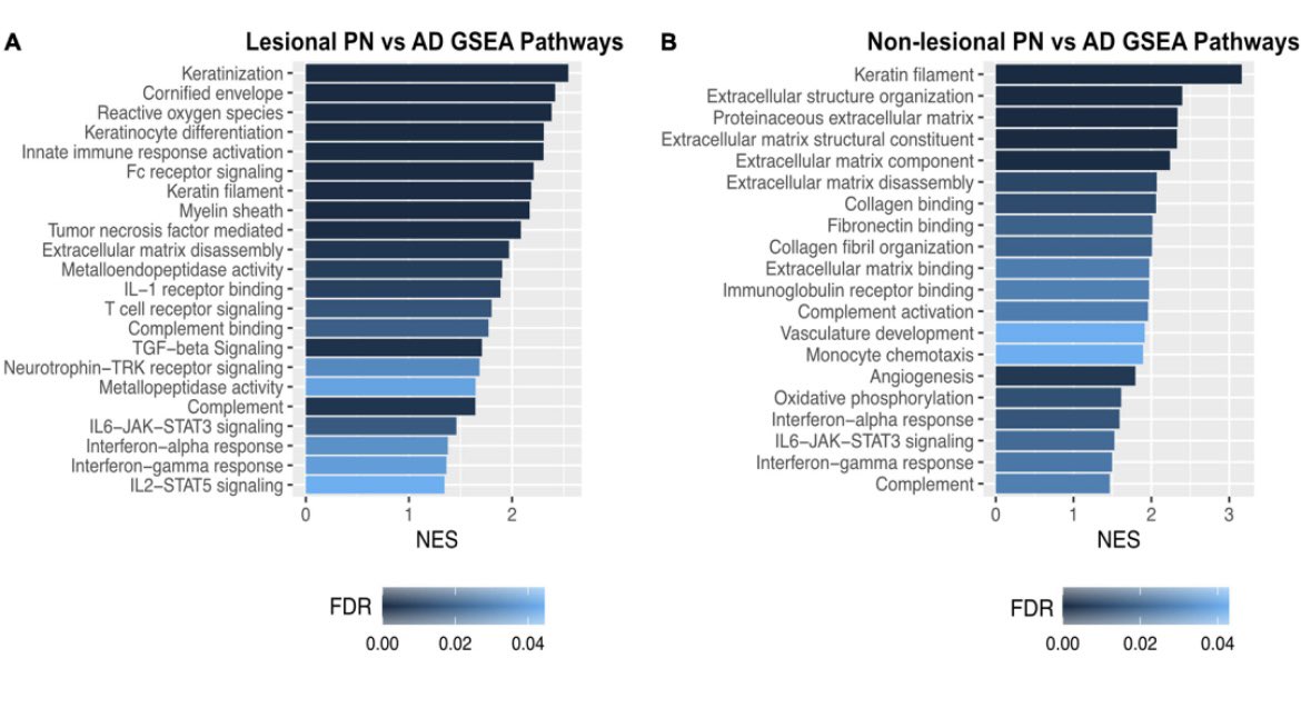 drshawnkwatra's tweet photo. Happy to share our study by @junedeng10 &amp; team on what’s unique in prurigo nodularis compared to atopic dermatitis - https://t.co/lEkVDe25jV

⬆️ TGF-beta signaling and dermal NGF

⬆️ OSM - in line with trial results showing failure of OSM inhibitors in AD but promising data in PN https://t.co/vQCQo9NGKO