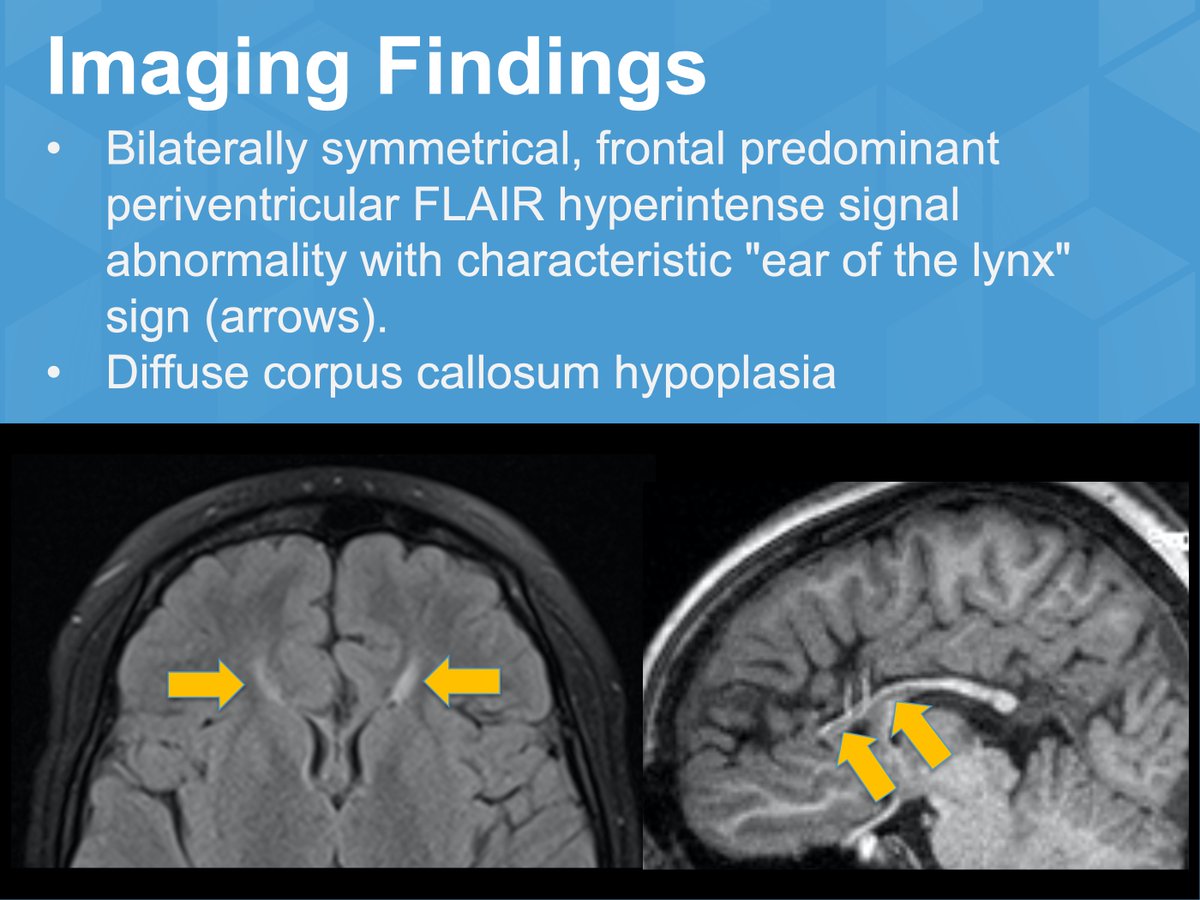 unc_neurorads's tweet photo. [202212 Case of Month]
Teenage girl with developmental delay and bilateral hyperreflexia

#unc_neurorads @uncradsresidency #pediatricneuroradiology #neuroradiology #pediatricneurology
#uppermotorneuron #spasticparaplegia #hereditaryspasticparaplegia https://t.co/F4ACvkCPur
