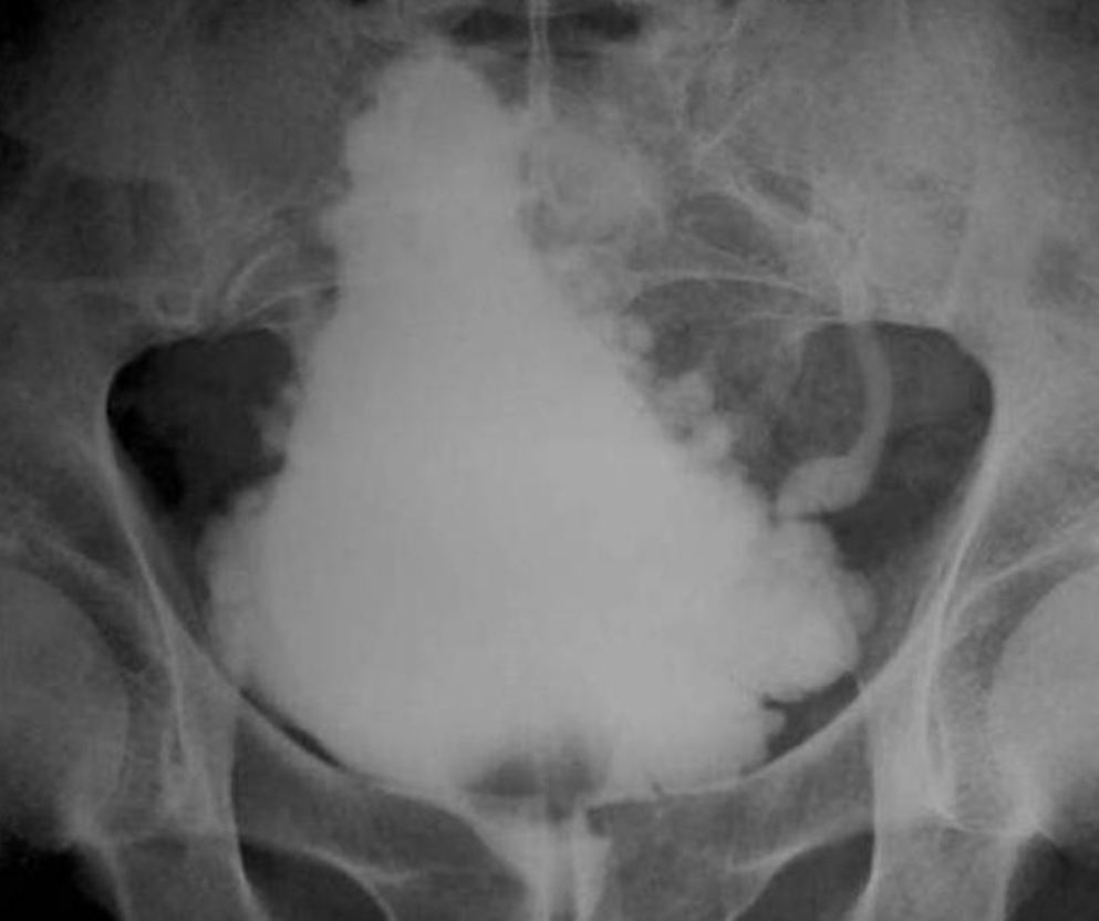 Holiday case series: What is the diagnosis for ‘#Christmas tree’ appearance of bladder on cystogram?