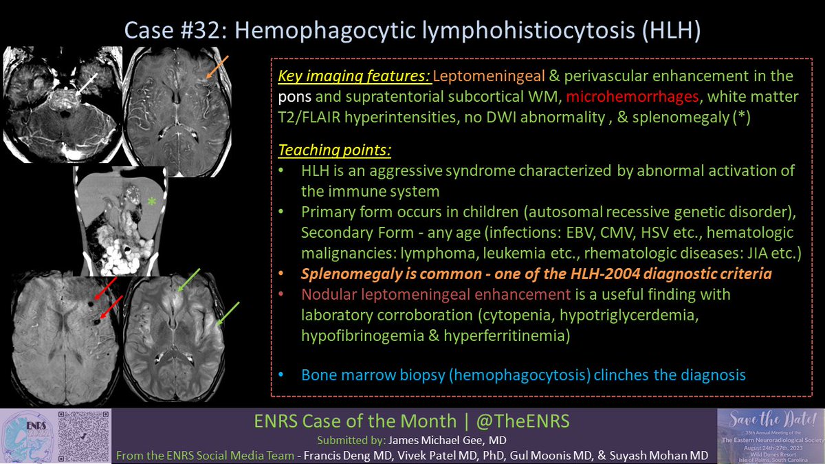The Eastern Neuroradiological Society (@theenrs) on Twitter photo Answer #ENRS Case of the MONTH (#32), Hemophagocytic lymphohistiocytosis (HLH).
Check out key features & salient teaching points!
Thanks <a href="/jmichaelgee/">J. Michael Gee</a> and <a href="/gmoonis/">Gul Moonis</a>
@tanyarathMD
<a href="/drsuyash/">Suyash</a>
<a href="/francisdeng/">Francis Deng, MD</a>
<a href="/amyfjuliano/">Amy Juliano</a> Answer #ENRS Case of the MONTH (#32), Hemophagocytic lymphohistiocytosis (HLH).
Check out key features & salient teaching points!
Thanks <a href="/jmichaelgee/">J. Michael Gee</a> and <a href="/gmoonis/">Gul Moonis</a>
@tanyarathMD
<a href="/drsuyash/">Suyash</a>
<a href="/francisdeng/">Francis Deng, MD</a>
<a href="/amyfjuliano/">Amy Juliano</a>