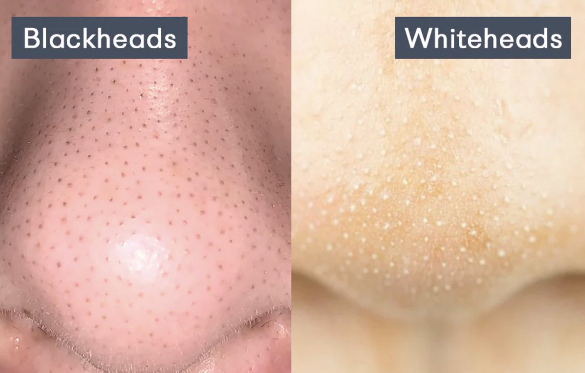 ezzahnor's tweet photo. Top 10 products for blackhead &amp; whitehead treatment 🤍✨

-A thread https://t.co/DI6KZNfGvP