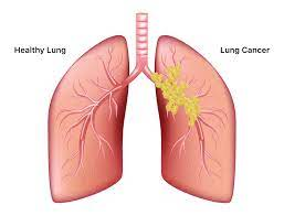 Lung cancers usually are grouped into two main types called small cell and non-small cell (including adenocarcinoma and squamous cell carcinoma). These types of lung cancer grow differently and are treated differently.