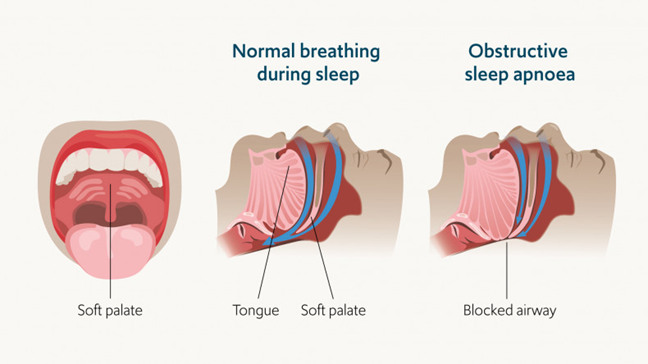 ckd_ce's tweet photo. 22) If untreated, #OSAHS is associated w/ neurocognitive impairment, adverse #cardiometabolic disease, &amp; all-cause ☠️
💤 Those living with undiagnosed OSAHS are 10x more likely to have a road traffic accident, so this affects the person living with the OSAHS as well as the public https://t.co/YHaSU5w6DJ