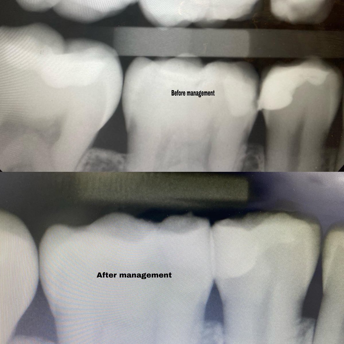emadalkamli's tweet photo. Pt diagnosed with reversible pulpitis ,Defective Restorations and Recurrent caries related to #45,46 which indicated for restoration redo rather than repair 
# 45,46 managed with indirect pulp capping 
With closed sandwiche and closed centripetal build up 
# 44 manged with PRR https://t.co/oqr19lwqlk