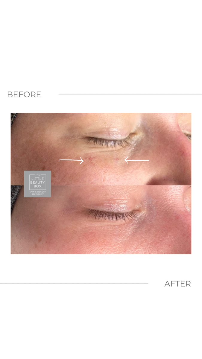 BeautyBoxLowton's tweet photo. 🎅🏼All I want for Christmas is a Thermavein treatment🎅🏼
When you have a threadvein under your eye for years and then you don’t!The power of this treatment is astonishing 🥰
Want to know more, Just ping a message over
#threadveinremoval
#spidervein
#miliaremovallowton
@thermavein https://t.co/tHoyfnnhlM