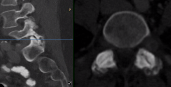 ChakravarthyMD's tweet photo. #InterestingCase
🔹54 year old👩
🔹CC: 4-week history of severe Left L5 radiculopathy.
What is your differential and surgical approach?
Something to think about while being stranded at the airport amid flight cancellations and winter weather.
#SafeTravels #HappyHolidays https://t.co/MmCKDVCMTH