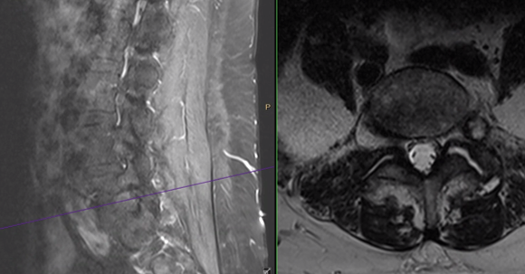ChakravarthyMD's tweet photo. #InterestingCase
🔹54 year old👩
🔹CC: 4-week history of severe Left L5 radiculopathy.
What is your differential and surgical approach?
Something to think about while being stranded at the airport amid flight cancellations and winter weather.
#SafeTravels #HappyHolidays https://t.co/MmCKDVCMTH