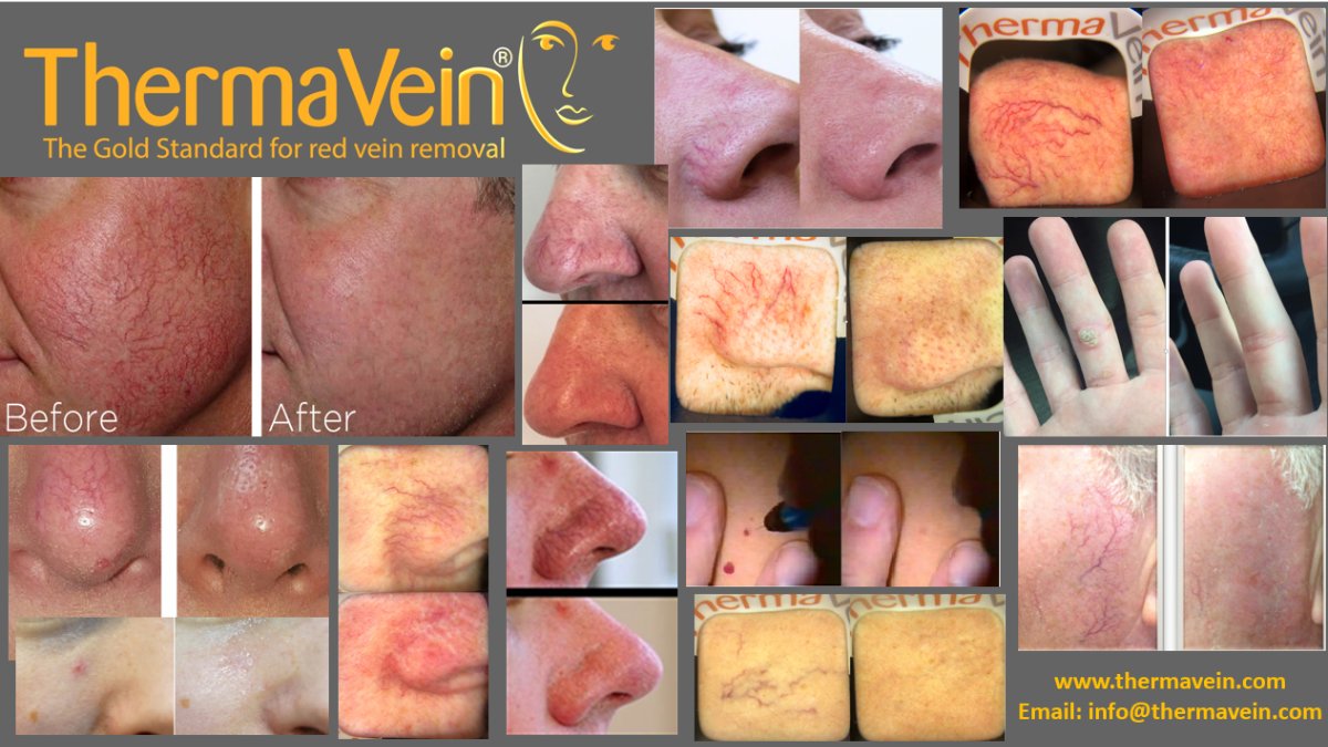 thermavein's tweet photo. And....back to work!
New year - New treatment! Introduce the amazing ThermaVein treatment into your clinic and get results for your clients and revenue for you!
Contact info@thermavein.com for more info
#thermavein #threadveins #redveins #veins #aesthetics #beauty https://t.co/I57k4xzrvw