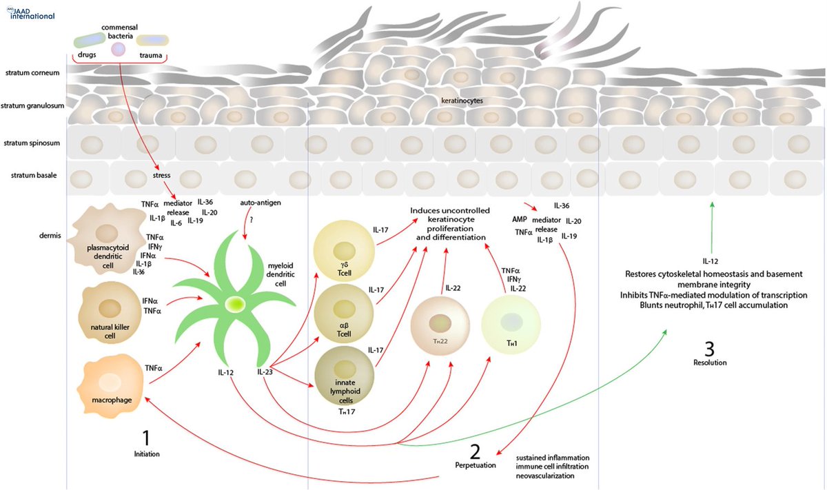 JAADjournals's tweet photo. The therapeutic landscape with psoriasis is rapidly evolving.  This review nicely summarizes the pathophysiology of psoriasis as well as the current state of biologic therapies. https://t.co/Iq1aiEGDDx https://t.co/Nlt71F8bkz