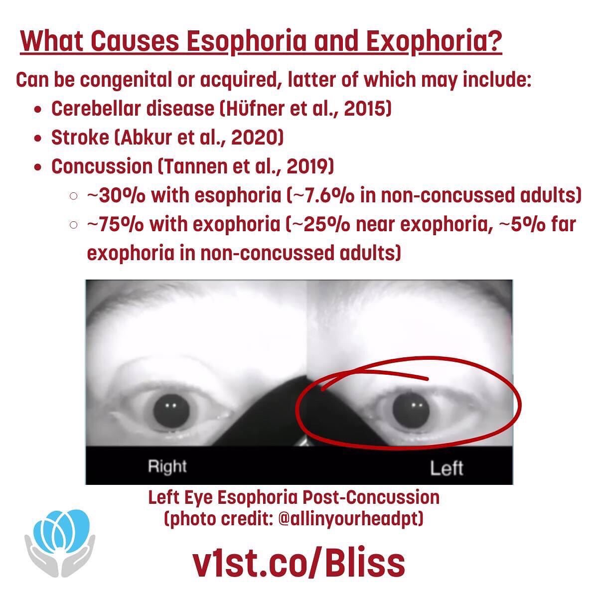 VestibularFirst's tweet image. Eye misalignment after concussion - is it contributing to your patient's headaches, difficulty reading, or fatigue? Learn more at our Jan 10th Journal Club or watch on-demand afterwards. Register v1st.co/Bliss #concussion #neurology #migraine #optometry #ophthalmology