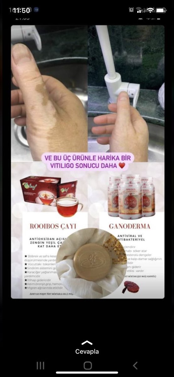 GanoExc38084481's tweet photo. Rt yaparmısınız 🥰👍🏻👍🏻

Evet işte vitiligo ürün kullanım sonucumuz, sizlerde kullanın bir çok rahatsızlıklarınızdan kurtulun 🥰🥰❤️Sipariş için Dm lütfen 😍🌹 https://t.co/GX6na833kX
