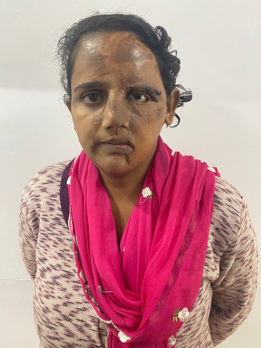 BraveSouls_NGO's tweet photo. Hands of innocent, or the guilty, acid sees no one.
It only burns. It only ruins.
#StopAcidSale #StopAcidAttack #Motivation #BraveSouls #AcidAttackSurvivors https://t.co/wgZLIBHTwB