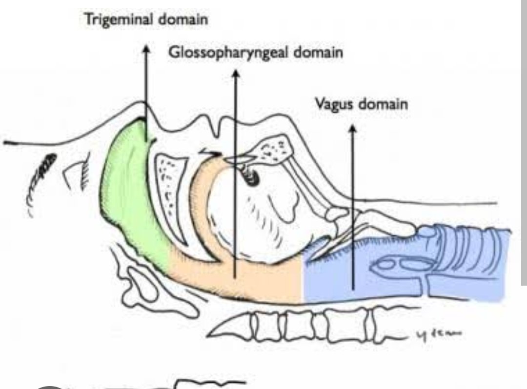 CarpenterAdam9's tweet photo. External approach, glossP. Under hyoid, Sup L. Trans tracheal, Rec L. Lidocaine. Awake and happy, VL down the throat. https://t.co/XUrlyl6BP7