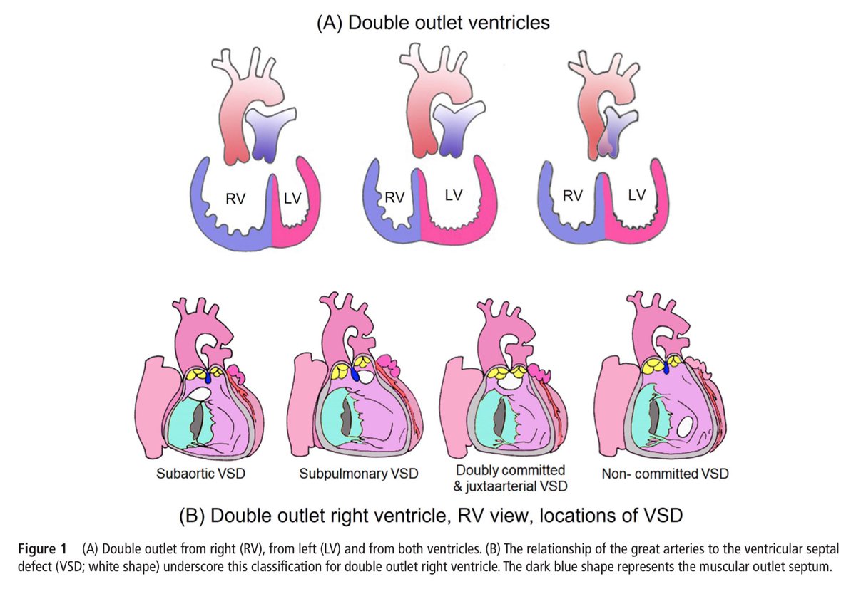 🔵 Double outlet ventricles: review of anatomic and imaging characteristics <a href="/Heart_BMJ/">Heart_BMJ</a> #ACHD #CardioEd #cardiology #CardioTwitter