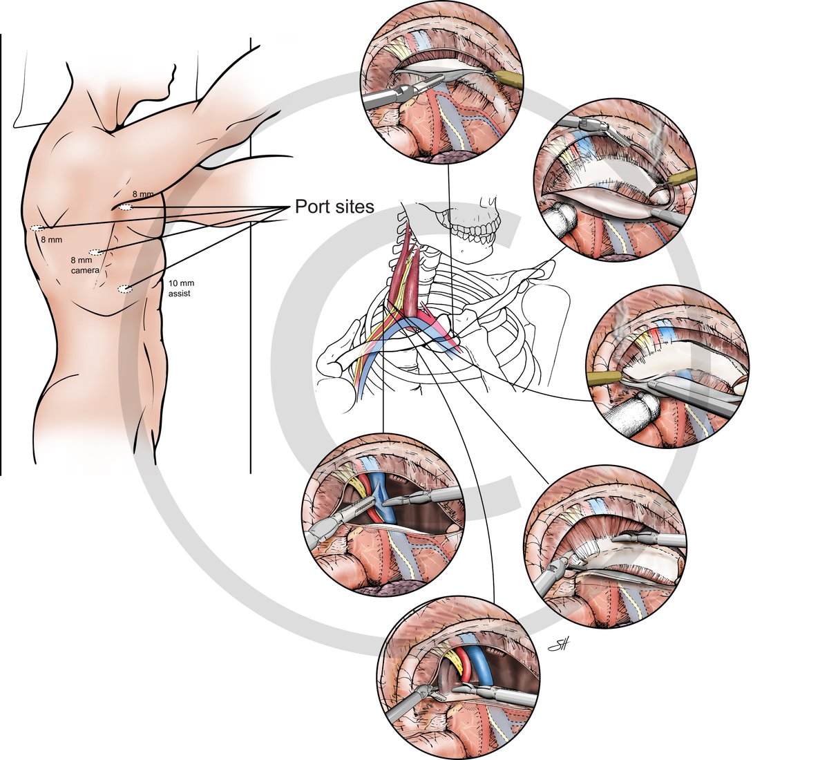 Finalizing robotic Thoracic Outlet Syndrome illustrations for an upcoming book chapter. @bcm_surgery <a href="/BMBurtMD/">Bryan M. Burt</a> <a href="/BCM_Thoracic/">David J. Sugarbaker Division of Thoracic Surgery</a> <a href="/DrRosengart/">Todd Rosengart, MD</a> <a href="/RTaylorRipley/">R. Taylor Ripley, M.D. Thoracic Surgeon</a>