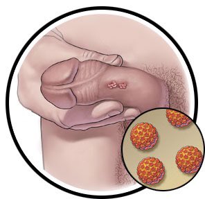 _elvis_simons's tweet photo. Protect yourself from Human Papillomavirus (HPV).

This viral infection can cause penile, cervical and throat cancer which can be life-threatening if not treated early.

Here is everything you must know about HPV: https://t.co/86mCwTqtSM