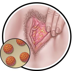 _elvis_simons's tweet photo. Protect yourself from Human Papillomavirus (HPV).

This viral infection can cause penile, cervical and throat cancer which can be life-threatening if not treated early.

Here is everything you must know about HPV: https://t.co/86mCwTqtSM