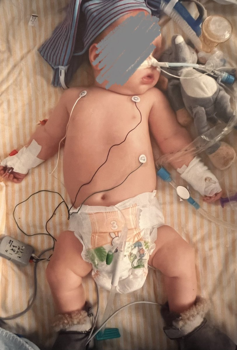 Mina barn och jag har varit storkonsumenter av svensk sjukvård (och är ff pga sonens kontroll av tumör). 
Nu när det är mycket rs-virus vill jag på riktigt VARNA alla med bebisar. Yngste drabbades för ca 13 år sen när han var 3 månader. Här kommer en bild hur det blev för honom: