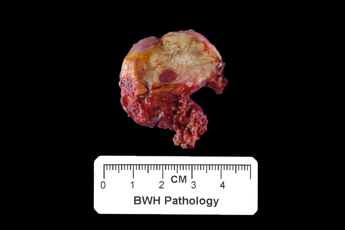 Hello and welcome to the Gross Case of the Week – Neuro Winter Edition! This week we have a trio of neuro cases that appear similar at first glance. #GrossCOTW #NeuroWinter
