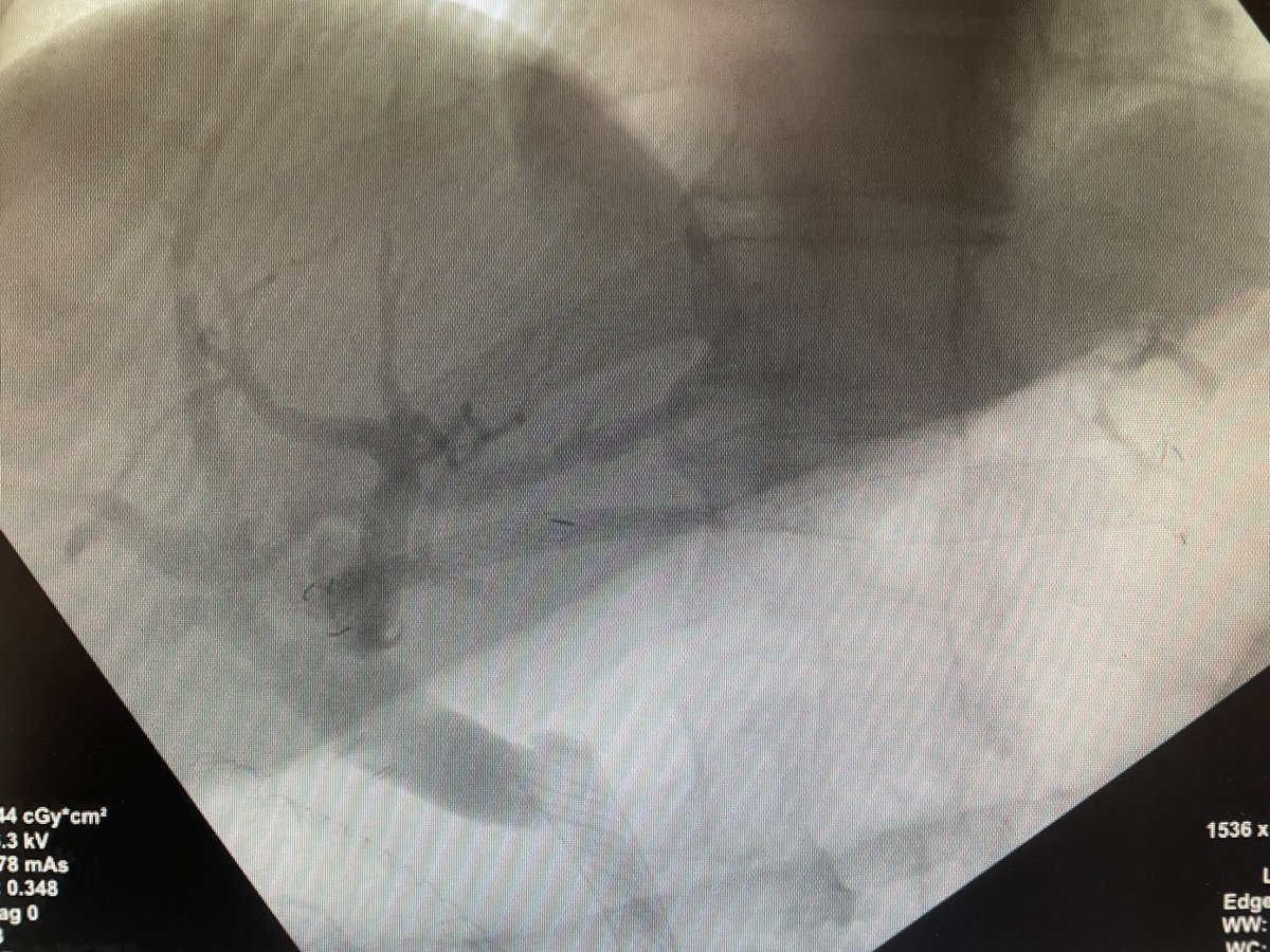 AymericBecq's tweet photo. What kind of crazy day was this? Duodenal stenting and hepaticogastrostomy (panc adenoCA w/ duod obstruction), double uncovered SEMS (hilar cholangioCA), spyglass w/ bx (indeterminate biliary stenosis) .. glad to have done this with such a great team! @AdilSoualy @GHUMondor https://t.co/PseKYlcYRz